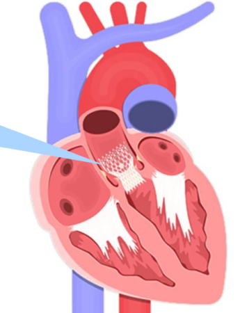 Minimally Invasive Transcatheter Heart Valve Surgery